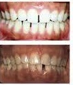 Before and after Invisalign treatment with teeth whitening at demė - Dental Services in Delaware