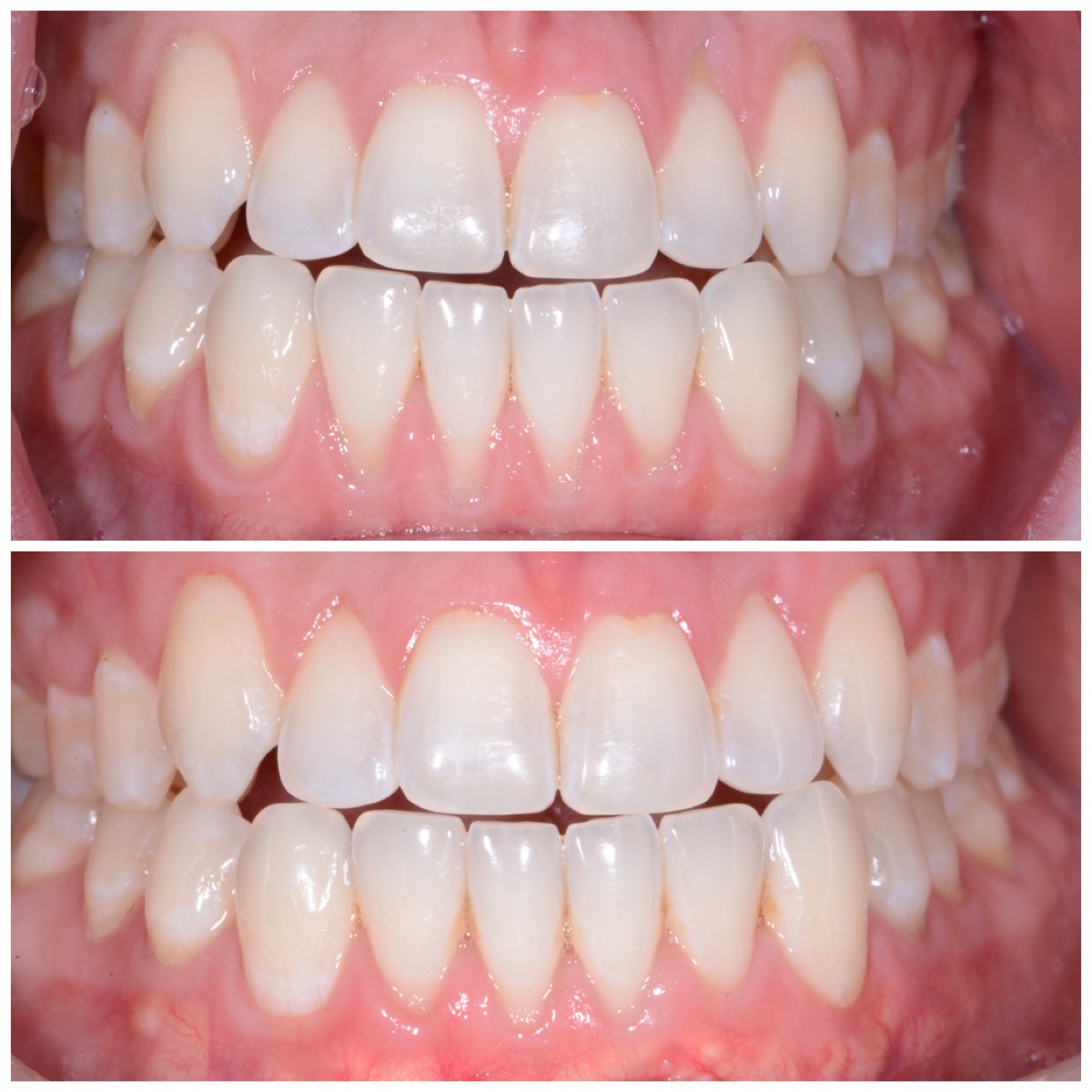 pinhole gum recession chestermere - receding gums pinhole gum recession chestermere - receding gums