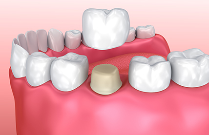 Dental Crowns Toronto - Dentistry Services by Dentists on Bloor