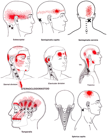 Massage and Headache Relief