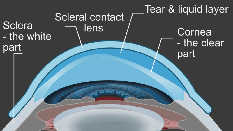 scleral-lenses-winnipeg